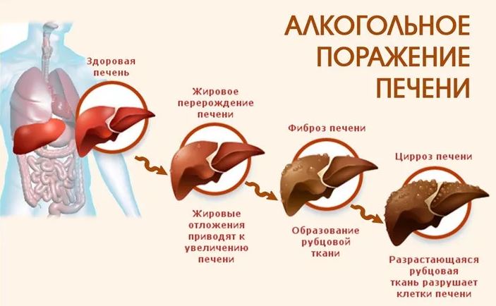 Алкогольное поражение печени