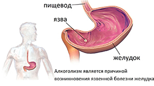Страдает микрофлора кишечника, можно получить язву